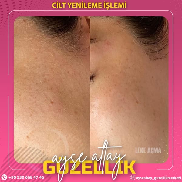 Ayşe Altay Güzellik Merkezi - 70. Fotoğraf