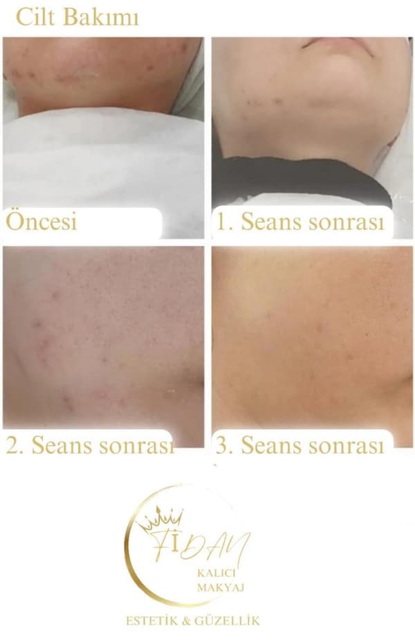 Fidan Kalıcı Makyaj Estetik Güzellik - 8. Fotoğraf Fidan Kalıcı Makyaj Estetik Güzellik - 8. Fotoğraf