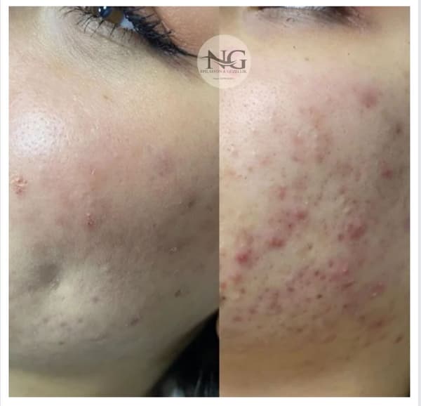 Nergis Epilasyon ve Güzellik - 13. Fotoğraf Nergis Epilasyon ve Güzellik - 13. Fotoğraf