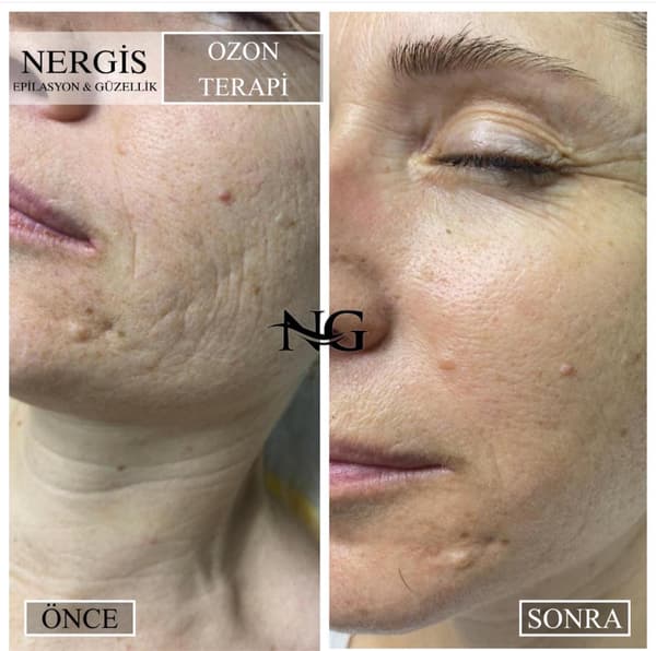 Nergis Epilasyon ve Güzellik - 3. Fotoğraf Nergis Epilasyon ve Güzellik - 3. Fotoğraf